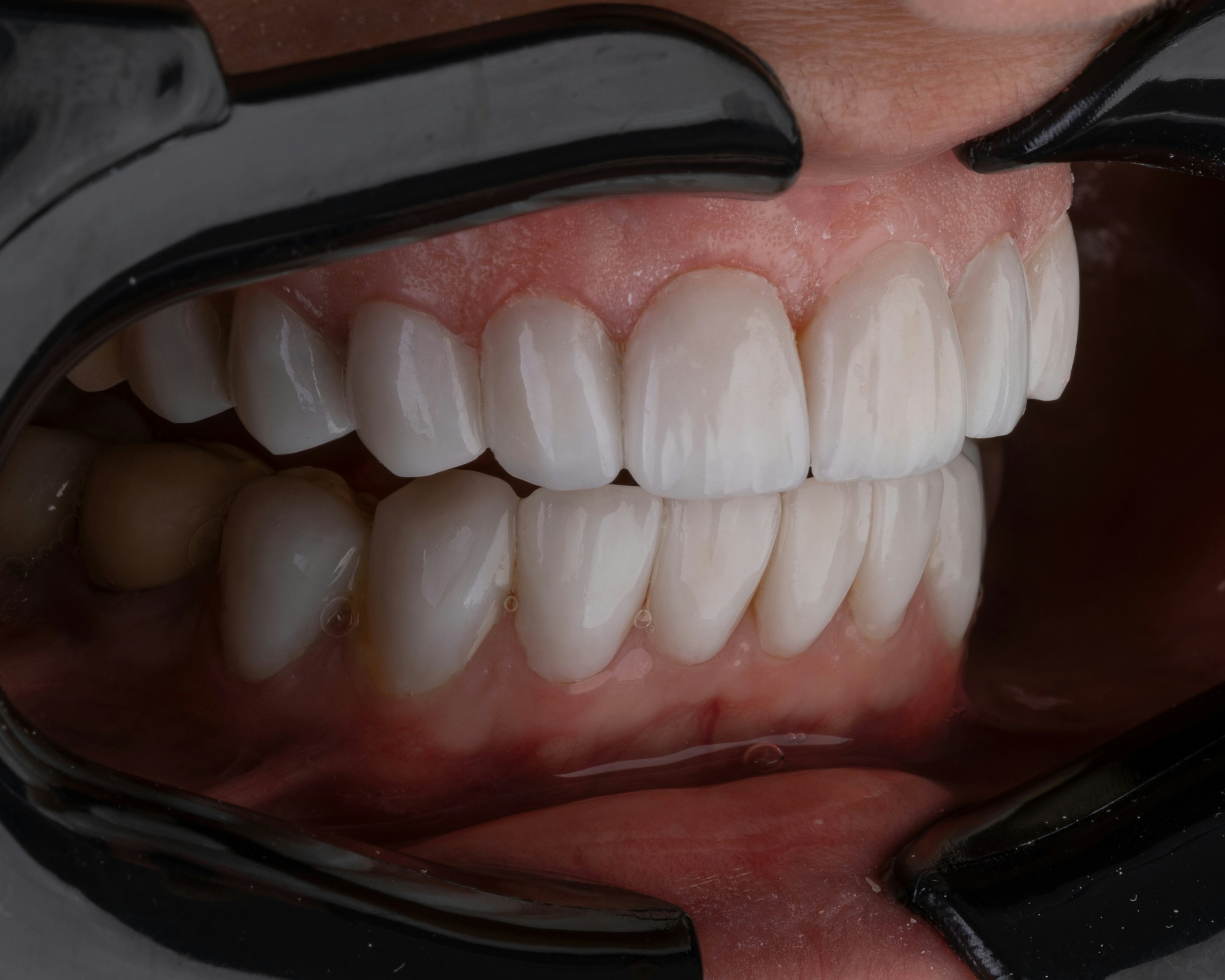 Close-up of a full-arch dental restoration