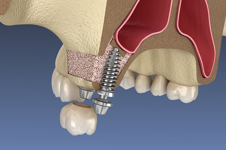 Illustration of a sinus lift and bone graft procedure