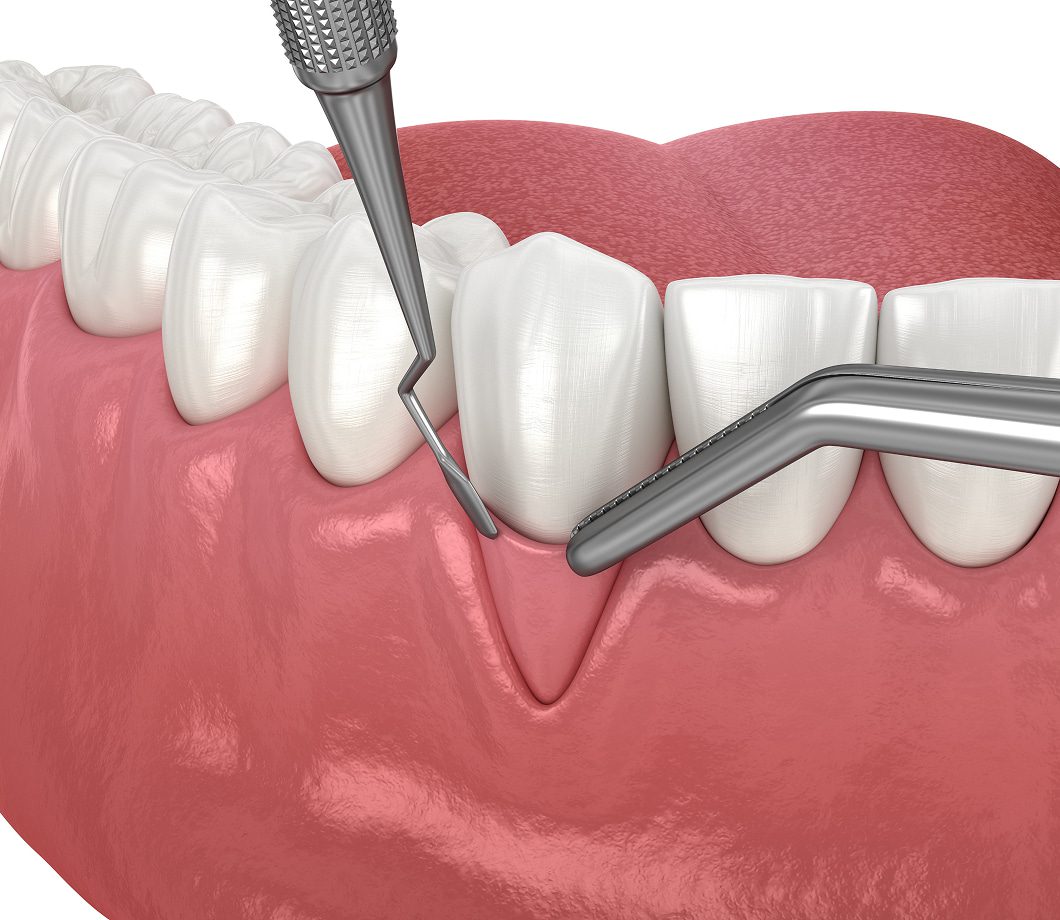 Bone and soft tissue grafting to support dental implants and improve oral function and aesthetics