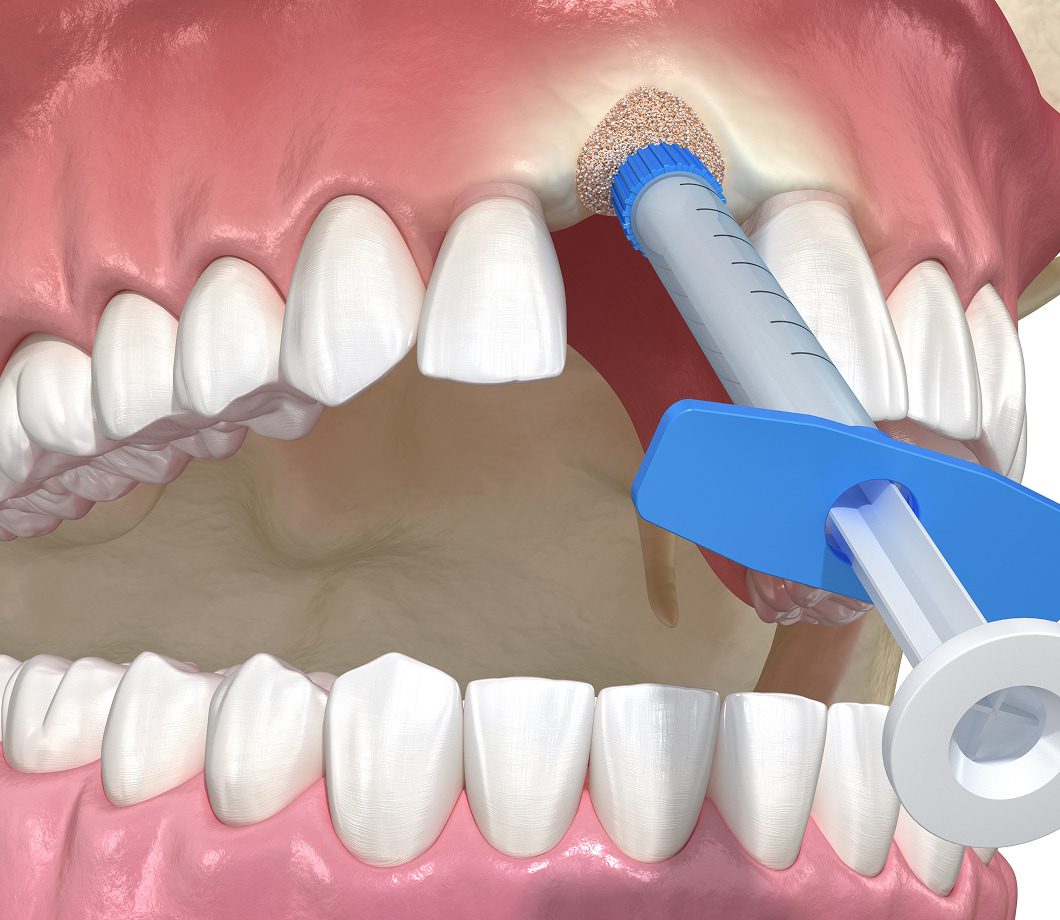Dental bone grafting procedure to rebuild jawbone before implant placement.