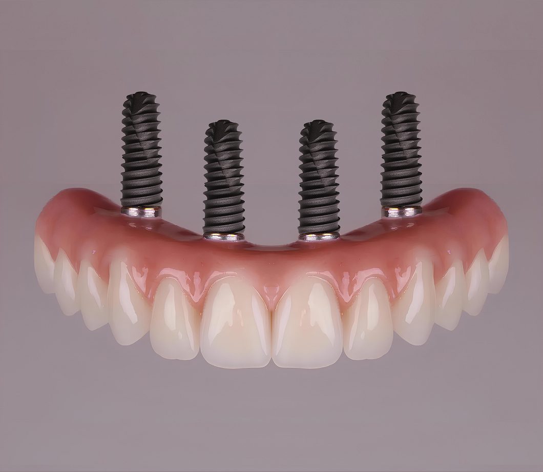 Full arch dental implants replacing a full row of teeth with multiple implant anchors