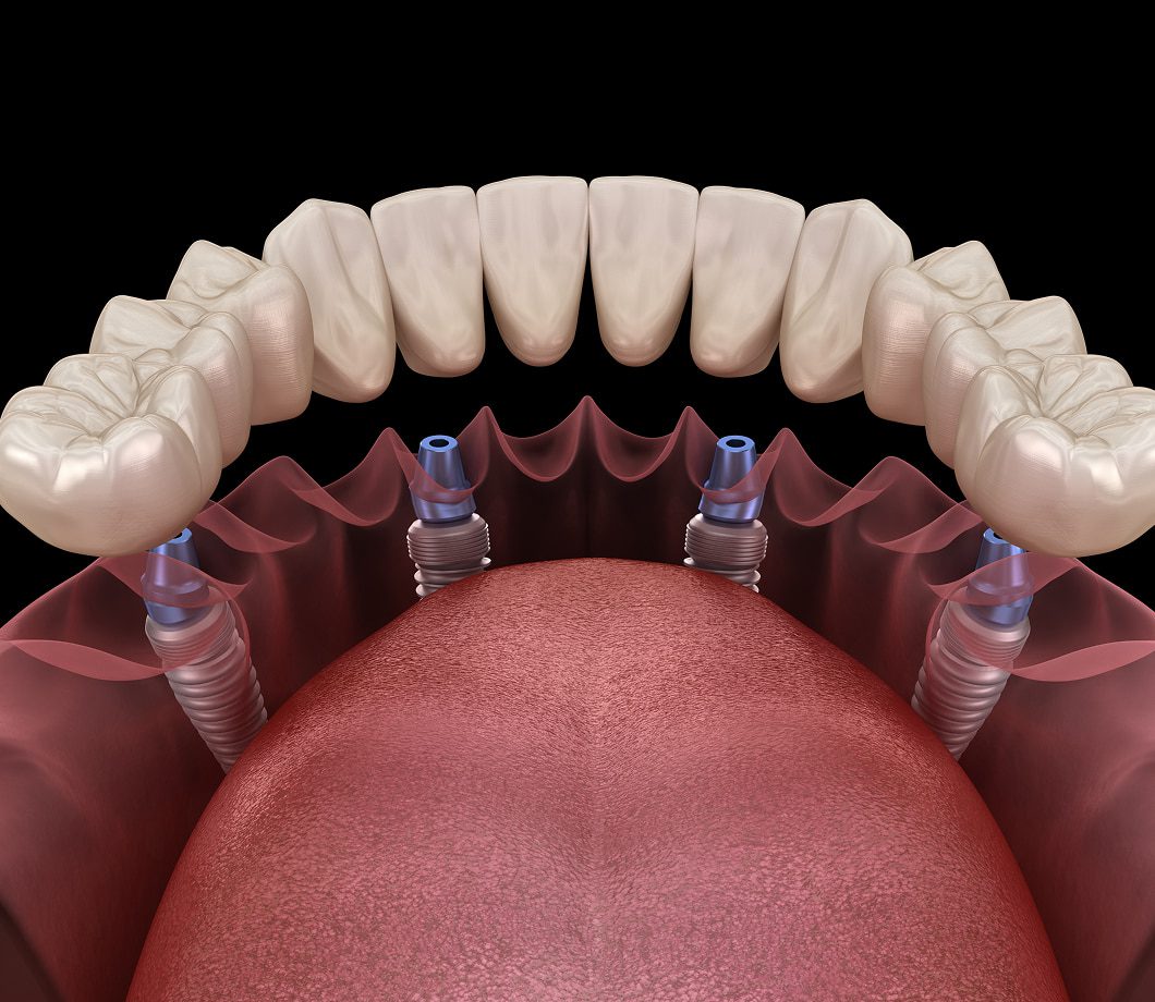 Benefits of full mouth dental implants restoring function, stability, and smile