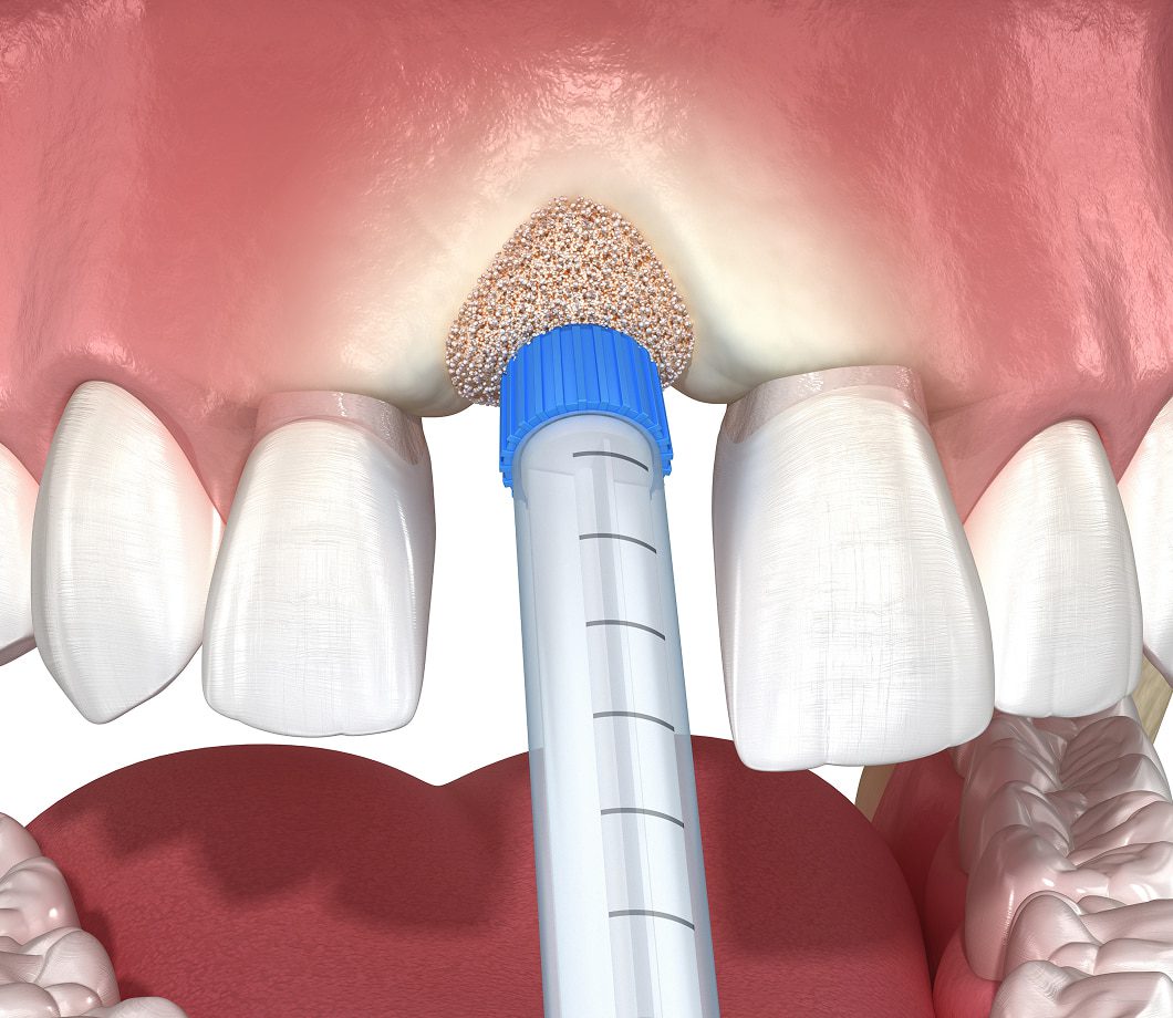 Benefits of grafting to restore bone and gum tissue for dental implants and facial structure.