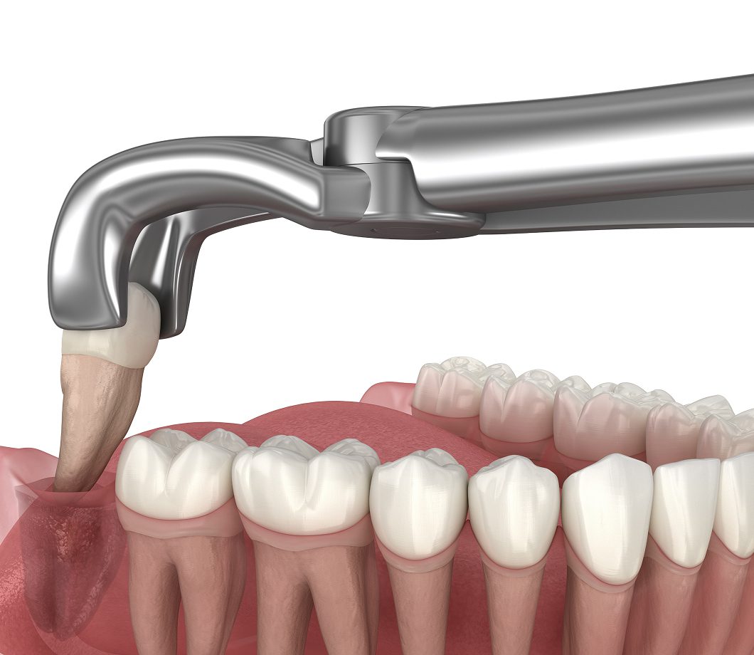 Wisdom teeth development, potential impaction, crowding, and oral complications