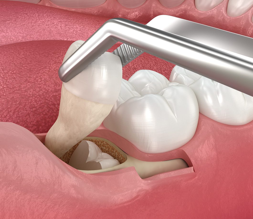 Risks and complications of wisdom teeth removal, including infection and dry socket