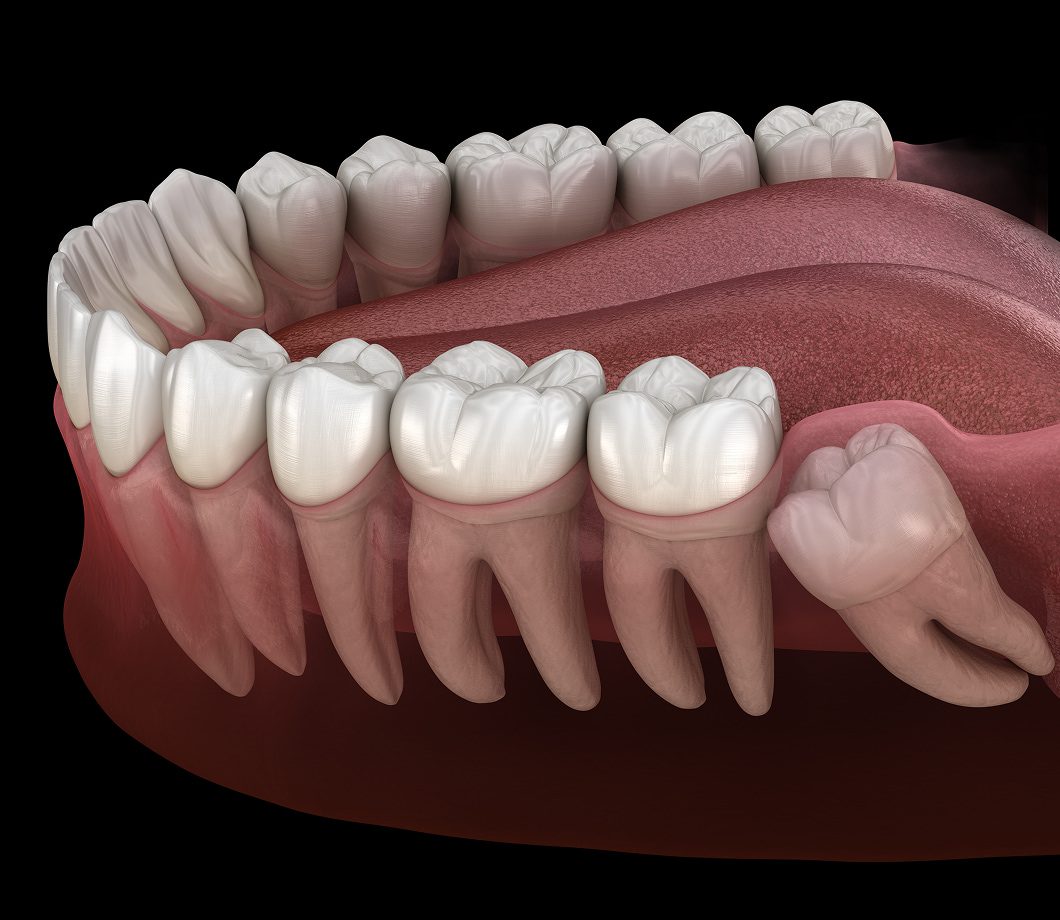 Candidates for wisdom teeth removal due to pain, crowding, or impaction
